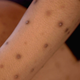 Image for article titled That's the Way the Pilar Cyst Bounces on Dr. Pimple Popper